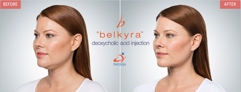 Tratamiento de la papada con Belkyra® sin cirugía